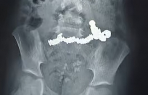 Emergency Surgery Saves UAE Boy Who Swallowed 52 Magnets