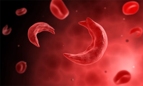 Sickle cell hub in Middle East urged Sickle cell hub in Middle East urged