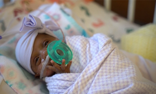 Like a large apple: World’s tiniest surviving baby in California Like a large apple: World’s tiniest surviving baby in California