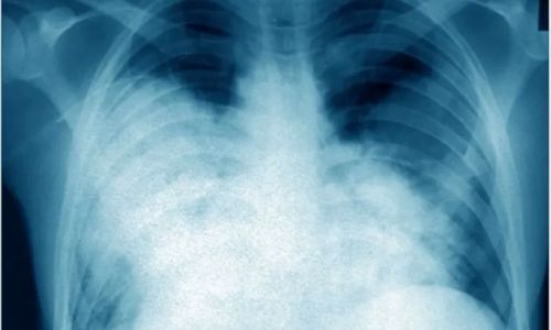 Legionnaires' disease behind mysterious illness that sickened 11, killed four in Argentina Legionnaires' disease behind mysterious illness that sickened 11, killed four in Argentina