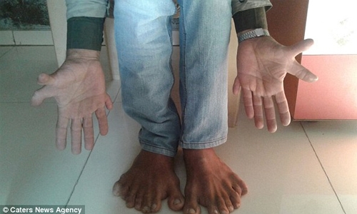 Indian carpenter with world record 28 fingers and toes