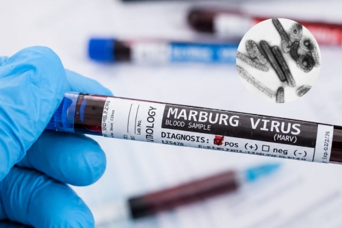 Marburg Virus Detected in Uganda Toddler Marburg Virus Detected in Uganda Toddler