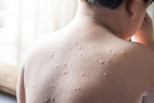 UN agency warns of ‘sharp increase’ in measles cases across Mexico, US