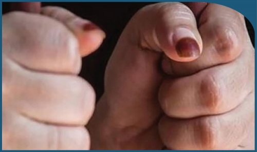 Teen Detained for Misusing Social Media and Targeting Person with Disabilities