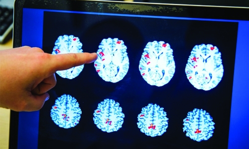 Head injury boosts dementia risk