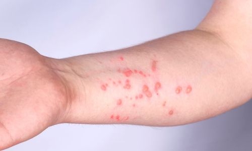 Steps taken to prevent spread of Monkeypox infections across schools in Bahrain 