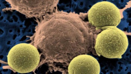 Killer T-cell therapy shows promise against leukemia