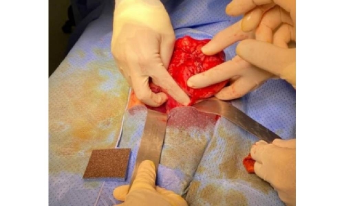 Successful nephrectomy performed at King Hamad University hospital
