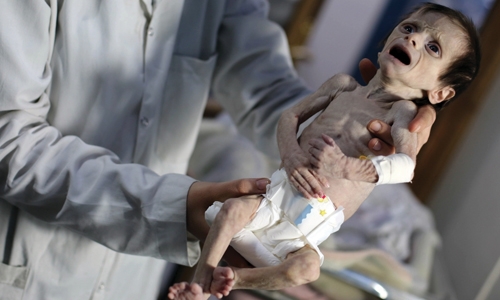 Image of starving baby ‘shocking’ : United Nations