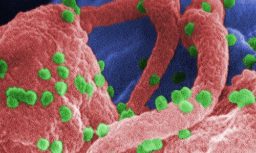 First woman ‘cured’ of HIV after stem cell transplant