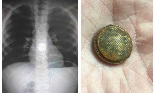 Successful operation for boy who ‘swallowed’ coin battery