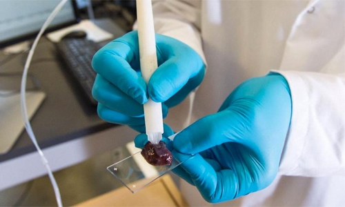 Pen-like tool helps surgeons spot cancer cells Pen-like tool helps surgeons spot cancer cells