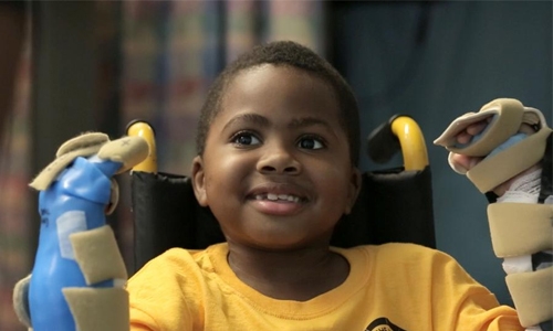 World's first child hand transplant a 'success'