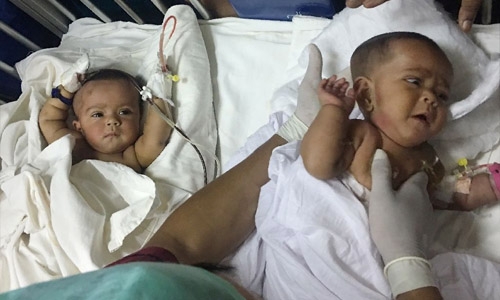 Bangladesh performs 'first' conjoined twin surgery