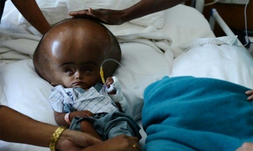 Indian girl with rare condition dies suddenly