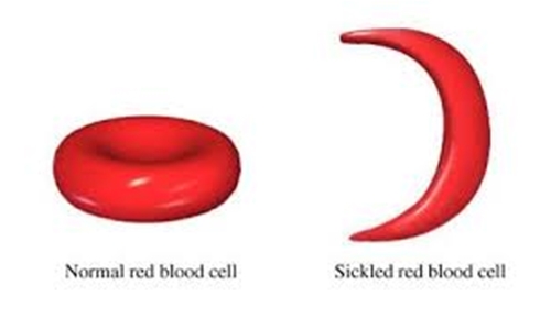 Call for more awareness on sickle-cell disease Call for more awareness on sickle-cell disease