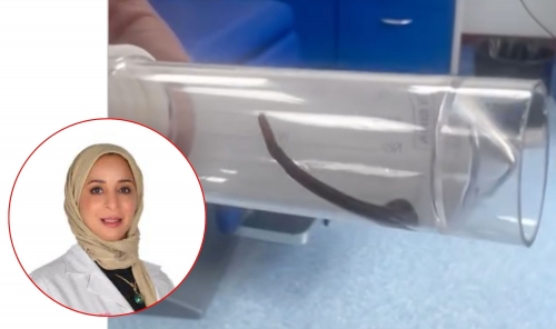 Live Leech Found Inside Patient's Nose After Nine-Day Ordeal Live Leech Found Inside Patient's Nose After Nine-Day Ordeal