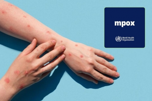 WHO Declares Ongoing Mpox Outbreak a Public Health Emergency, Issues Revised Recommendations