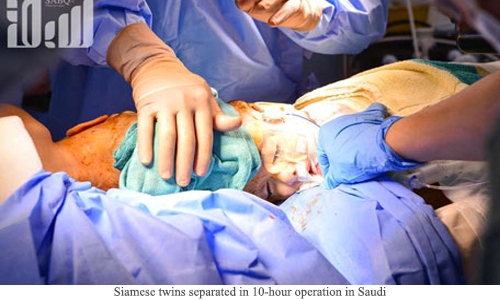 Siamese twins separated in 10-hour operation in Saudi