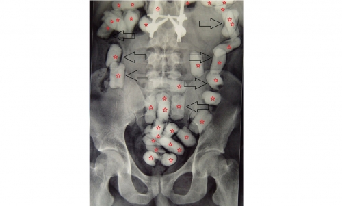 Drugs found in man’s abdomen Drugs found in man’s abdomen