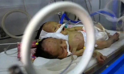 Saudi team ready to treat conjoined Yemeni twins