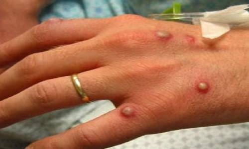 Bangladesh declares health alert amid monkeypox outbreak