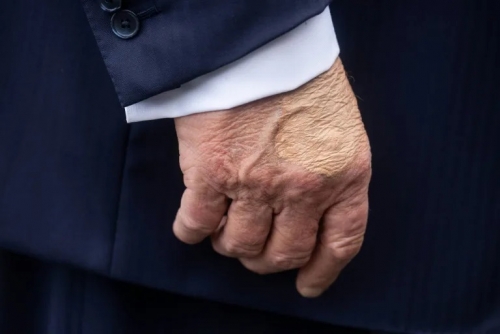 Trump diagnosed with vein issue after leg swelling and hand bruising Trump diagnosed with vein issue after leg swelling and hand bruising