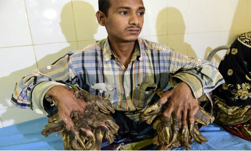 Surgery for Bangladesh's 'Tree Man' to remove warts
