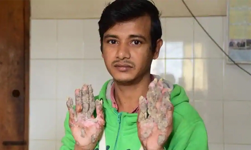 Bangladesh ‘Tree Man’ returns to hospital as condition worsens