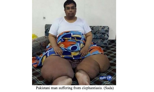 Prince orders treatment for 'elephantiasis' Prince orders treatment for 'elephantiasis'