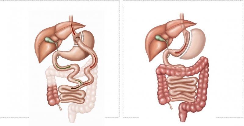 Surgery saves obese man Surgery saves obese man