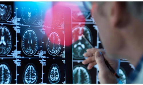 Stroke Rates Double Among Younger Adults 