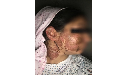 Bahraini ex-con husband attacks former wife with acid