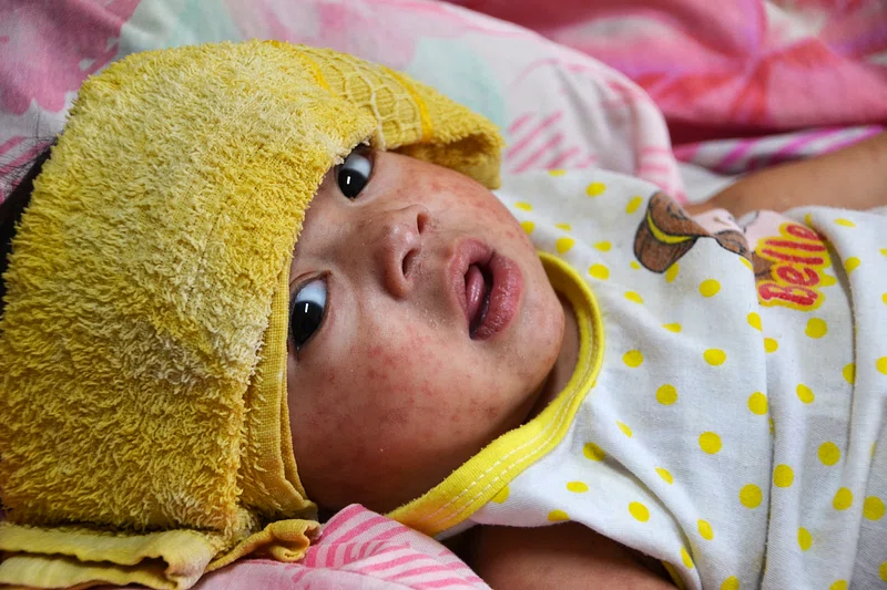 Global Measles Outbreaks Surge: UN Warns 30 Million Children Are Unprotected Global Measles Outbreaks Surge: UN Warns 30 Million Children Are Unprotected