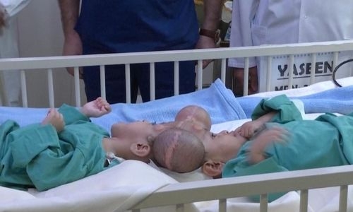Doctors in Saudi Arabia successfully separated conjoined twins after 15-hour surgery