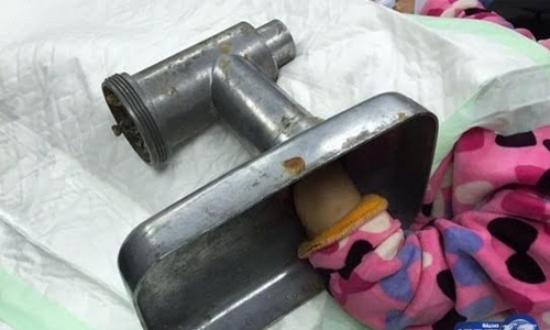 Child saved after hand caught in meat mincer Child saved after hand caught in meat mincer