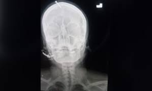 Pregnant woman gets nail hammered into her head to give birth to a baby boy in Pakistan 