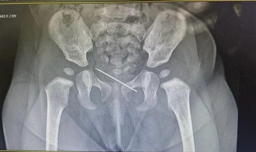 Al Hilal medical team saves infant's life by removing needle from pelvis Al Hilal medical team saves infant's life by removing needle from pelvis