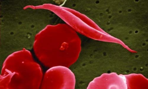 No ban on sickle cell anaemia drug: Ministry
