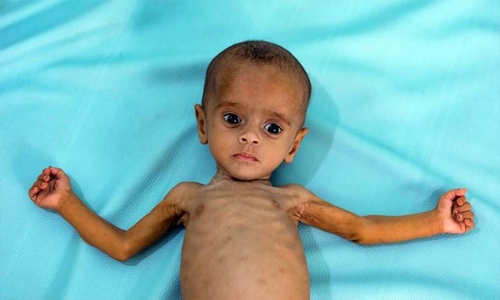 Yemen in 'imminent danger' of world's worst famine in decades: UN
