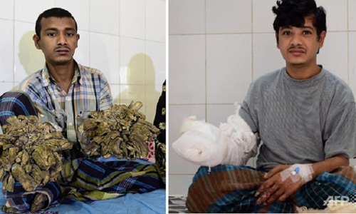 Bangladesh 'Tree Man' sees hope after 16 surgeries