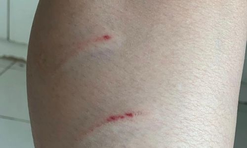 Pregnant woman attacked by stray dogs in Hamad Town