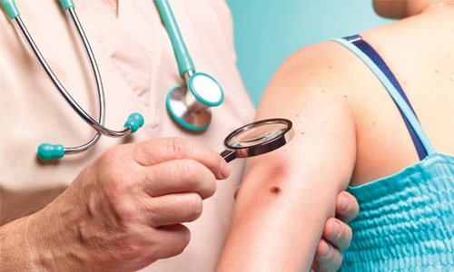 Protein to control skin cancer spread