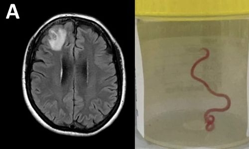 Australian doctors find live parasitic worm in woman’s brain