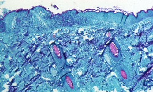 Monkeypox cases will not explode in same way as Covid-19, experts say Monkeypox cases will not explode in same way as Covid-19, experts say