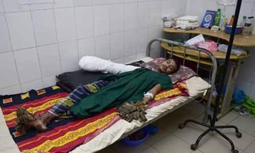 Bangladesh's 'Tree Man' may need dozen more operations Bangladesh's 'Tree Man' may need dozen more operations