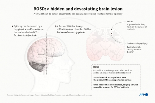 AI tool helps researchers treat child epilepsy