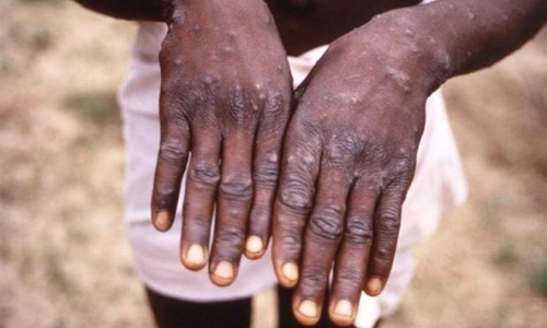 First case of monkeypox virus detected in Singapore