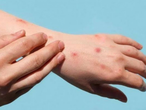 Saudi Arabia reports two new monkeypox cases