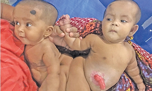 Walking, talking and separated: Bangladesh conjoined twins Walking, talking and separated: Bangladesh conjoined twins